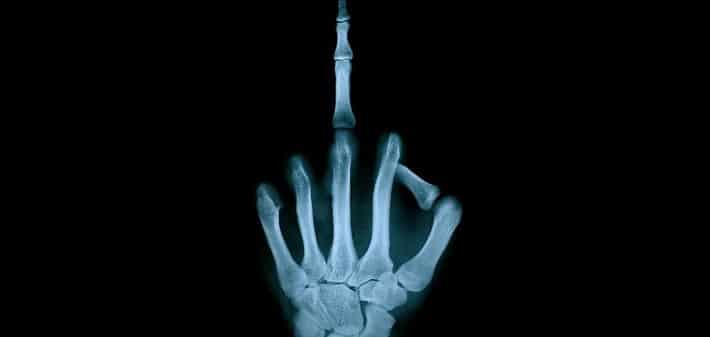 an x-ray of a hand with the middle finger extended